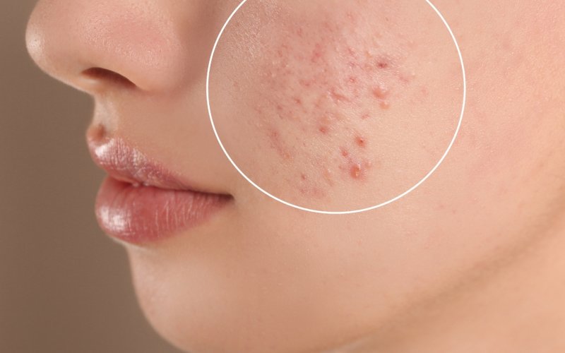 Leke ve Akne İzleriyle Nasıl Vedalaşılır?